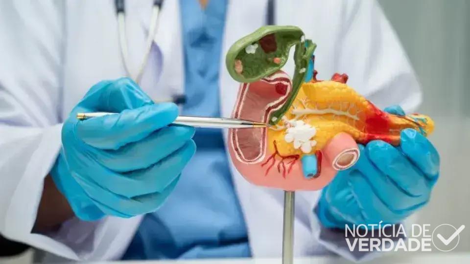 Avanços Promissores no Tratamento do Câncer de Pâncreas
